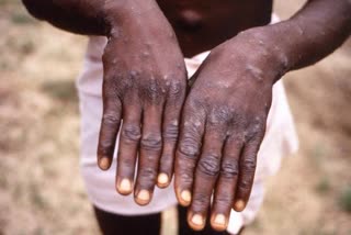 First case of monkeypox in Israel