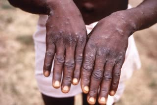 Monkeypox Outbreak: ବେଲଜିୟମରେ ବାଧ୍ୟତାମୂଳକ ହେଲା କ୍ବାରେଣ୍ଟାଇନ