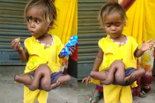 CHILD WITH 4 HAND 4 LEG IN NAWADA