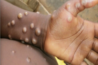 ICMR scientist says India prepared for monkeypox