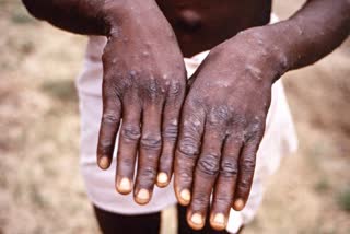 Monkeypox infection