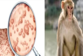 Health department on alert in Madhya Pradesh regarding monkeypox