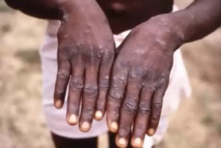 Mexico Confirms First Case of Monkeypox