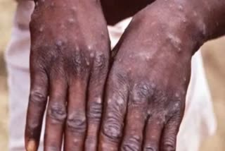 Monkeypox virus suspected case in Ghaziabad