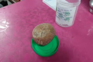 In a rare operation 300 gm stone removed from urinary bladder