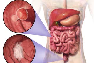 Cancer Vanishes For Every Patient In Drug Trial  Cancer Vanishes For Every Patient In Drug Trial in newyork  പരീക്ഷണഘട്ടത്തില്‍ ഫലം കണ്ട് മലാശയ അർബുദത്തിനുള്ള മരുന്ന്  ന്യൂയോര്‍ക്കില്‍ മലാശയ അർബുദത്തിനുള്ള മരുന്ന് ഫലപ്രദമെന്ന് കണ്ടെത്തി