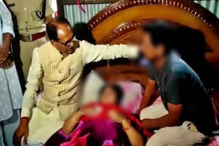 Bhopal: Woman receives 118 stitches on face for resisting eve teasing, CM calls for strict action against accused