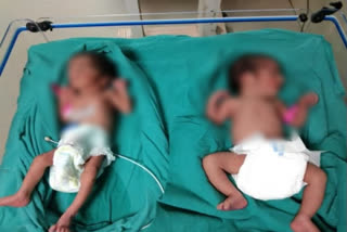 Mentally unstable woman abandons twins in Surat hospital