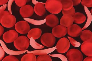 World Sickle Cell Day 2022
