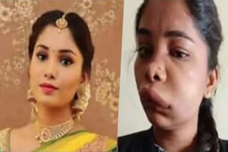 kannada actor root canal gone wrong  kannada actor swathi sathish  swathi sathish unrecognisable after root canal  kannada actor swollen face after root canal  റൂട്ട് കനാൽ ശസ്ത്രക്രിയ കന്നട താരം സ്വാതി സതീഷ്  റൂട്ട് കനാൽ ചികിത്സ പിഴവ്