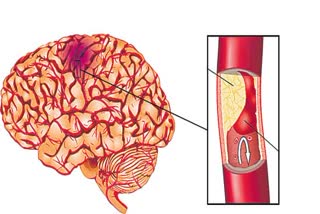 jaundice temporary symptoms