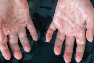 doctor-advice-on-how-to-stay-well-from-monkeypox