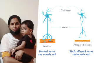 sma medicine from america  gowri lekshmi admitted in hospital for the treatment of sma disease  sma disease  gowri lekshmi  gowri lekshmi admitted in hospital  ഗൗരി ലക്ഷമിയെ ആശുപത്രിയിൽ പ്രവേശിപ്പിക്കും  ചികിത്സക്കായി ഗൗരി ലക്ഷമിയെ ആശുപത്രിയിൽ പ്രവേശിപ്പിക്കും  അമേരിക്കയിൽ നിന്നും മരുന്നെത്തിച്ചു  ഗൗരി ലക്ഷമി ചികിത്സ സഹായ സമിതി  സ്പൈനൽ മസ്‌കുലർ അട്രോഫി രോഗം ബാധിച്ച പാലക്കാട് ഷൊർണൂർ സ്വദേശി ഗൗരി ലക്ഷമി  സ്പൈനൽ മസ്‌കുലർ അട്രോഫി രോഗം  ഗൗരി ലക്ഷമിയുടെ ചികിത്സക്കായുള്ള മരുന്ന് യുഎസ് കമ്പനിയിൽ നിന്ന് എത്തിച്ചു  ഗൗരി ലക്ഷമിയുടെ ചികിത്സക്കായുള്ള മരുന്ന് യുഎസ് കമ്പനിയിൽ നിന്ന് കോഴിക്കോട്ടെ സ്വകാര്യ ആശുപത്രിയിലെത്തിച്ചു  ഗൗരി ലക്ഷമിക്ക് ചികിത്സ സഹായവുമായി എം എ യൂസഫലി