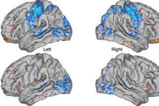 Anterior thalamocortical functional connectivity changes before and after Yoga Nidra meditation in expert meditators