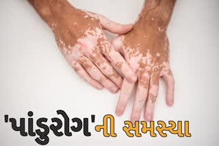 પાંડુરોગની સમસ્યાને સમજવી