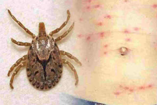 ten people infected in Scrub Typhus admitted in Kolkata hospitals