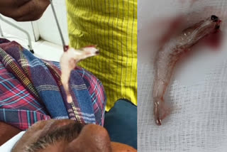 andhra pradesh prawn removed from nose  doctor removes live prawn from man nose in ap  bhimavaram prawn stuck inside nose  ആന്ധ്രാപ്രദേശ്‌ ചെമ്മീന്‍ മൂക്കില്‍ കുടുങ്ങി  മൂക്കില്‍ നിന്നും ജീവനുള്ള ചെമ്മീന്‍ പുറത്തെടുത്തു  ഭീമാവരം മൂക്കില്‍ നിന്ന് ചെമ്മീന്‍ പുറത്തെടുത്തു