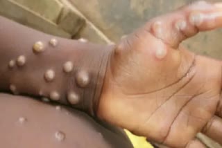 not-monkeypox-foreign-returns-student-infected-with-chickenpox