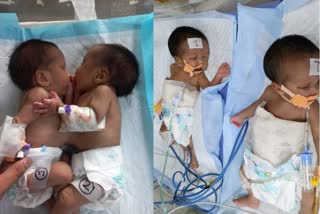 NRS doctors perform rare surgery to separate conjoined babies