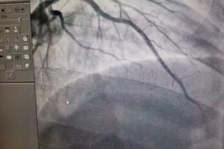 Unique treatment of heart blockage in Mekahara Raipur