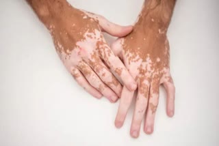 Vitiligo: ଜାଣନ୍ତୁ ଛଉ ରୋଗ ହେବାର କାରଣ