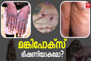 what is monkeypox  everything you need to know about Monkeypox virus  മങ്കിപോക്‌സ് കേരളത്തിലും  എന്താണ് മങ്കിപോക്‌സ്  വാനര വസൂരി  കുരങ്ങ് വസൂരി  monkey pox in kerala  monkeypox history  monkeypox latest news  മങ്കിപോക്സ് ചരിത്രം  മങ്കിപോക്സിനെ കുറിച്ച് അറിഞ്ഞിരിക്കേണ്ടവ  മങ്കിപോക്സ ലക്ഷണങ്ങൾ  monkeypox symptoms and precaution  മങ്കിപോക്സ് മുൻകരുതൽ