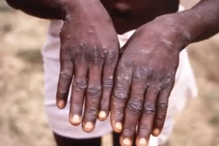 Monkeypox: କେରଳରୁ ଚିହ୍ନଟ ପ୍ରଥମ ସନ୍ଦିଗ୍ଧ, UAEରୁ ଫେରିଥିବା ସୂଚନା