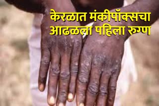 First Monkey Pox Case In India