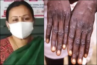 monkey pox alert veena george statement  മങ്കിപോക്‌സ് ജില്ലകള്‍ക്ക് ജാഗ്രതാനിര്‍ദേശം  മങ്കിപോക്‌സ് ആശങ്കപ്പെടേണ്ടതില്ലെന്ന് ആരോഗ്യ മന്ത്രി  what is monkey pox  prevention against monkey pox