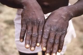 Monkeypox: Kerala issues special alerts to 5 districts