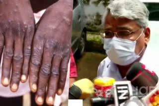 monkey pox kerala  monkey pox india  central team at kerala  kerala health department  മങ്കി പോക്‌സ് കേരളത്തിൽ  കേന്ദ്ര സംഘം കേരളത്തിൽ  ആരോഗ്യ മന്ത്രി വീണ ജോർജ്