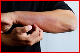 Increase in Skin Disorder Patients