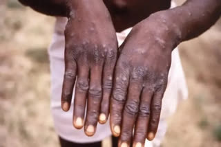 MONKEYPOX: విజయవాడలో ‘మంకీ పాక్స్‌’ కలకలం