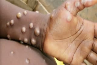 Monkeypox WHO News