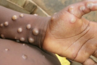 Monkeypox infection found in Delhi man with no travel history