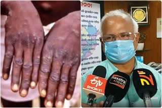 Monkeypox Tension: ବାହାର ଯାତ୍ରୀଙ୍କ ଉପରେ ନଜର ରହିଛି କହିଲା ବିଭାଗ