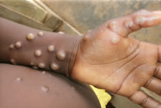 Monkeypox alert in Rajasthan as WHO declare it global health emergency