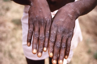 Monkeypox