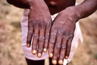 Monkeypox Scare: ମଙ୍କିପକ୍ସକୁ ନେଇ ଆର୍ଲଟ ରାଜ୍ୟ ସରକାର, 30ରେ ସ୍ୱାସ୍ଥ୍ୟ ବିଭାଗର ଉଚ୍ଚସ୍ତରୀୟ ବୈଠକ