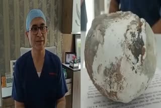 DR ASHISH PATIL REMOVED A LUMP OF ABOUT ONE KG FROM THE FARMERS STOMACH