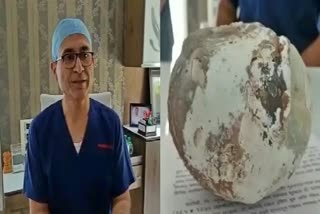 Surgeon  removed one kg kidney stone