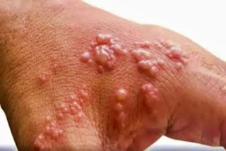 Spain registers monkeypox death, Monkeypox death news, How to Monkeypox speard, What is Monkeypox, Monkeypox 2022 news, ಸ್ಪೇನ್​ನಲ್ಲಿ ಮಂಕಿಪಾಕ್ಸ್​ನಿಂದ ವ್ಯಕ್ತಿ ಸಾವು, ಮಂಕಿಪಾಕ್ಸ್ ಸಾವಿನ ಸುದ್ದಿ, ಮಂಕಿಪಾಕ್ಸ್ ಹರಡುವುದು ಹೇಗೆ, ಮಂಕಿಪಾಕ್ಸ್ ಎಂದರೇನು, ಮಂಕಿಪಾಕ್ಸ್ 2022 ಸುದ್ದಿ,