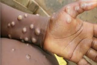One person dies of monkeypox in Spain