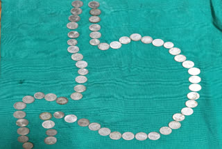 61 coins removed from stomach of a youth in MDM hospital of Jodhpur