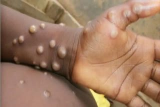 India records first death due to monkeypox