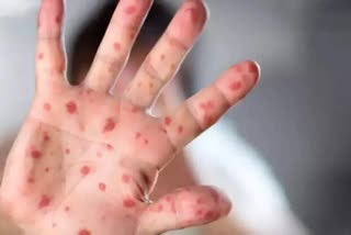 monkeypox case confirmed in kerala  monkeypox cases in kerala  monkeypox death minister veena george  ഒരാൾക്ക് കൂടി മങ്കിപോക്‌സ്  മങ്കിപോക്‌സ് രോഗബാധിതർ  മങ്കിപോക്‌സ് മരണം  ആരോഗ്യമന്ത്രി വീണ ജോർജ്
