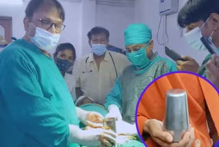 Doctors remove steel glass from patient stomach