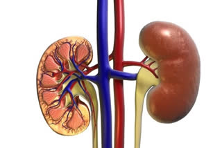 Small Kidney Stones