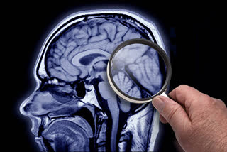 Alzheimer's may lead to loss of visual memory, says study