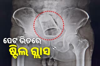 MKCG ମେଡିକାଲରେ ବିରଳ ଅସ୍ତ୍ରୋପଚାର, ପେଟ ଭିତରୁ ବାହାରିଲା ଷ୍ଟିଲ ଗ୍ଲାସ